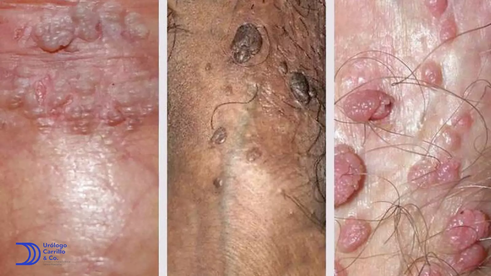 Apariencia de verrugas genitales en hombres en distintos tonos de piel 