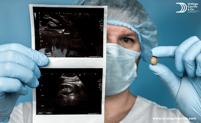 El médico puede diagnosticar la formación de un cálculo renal
