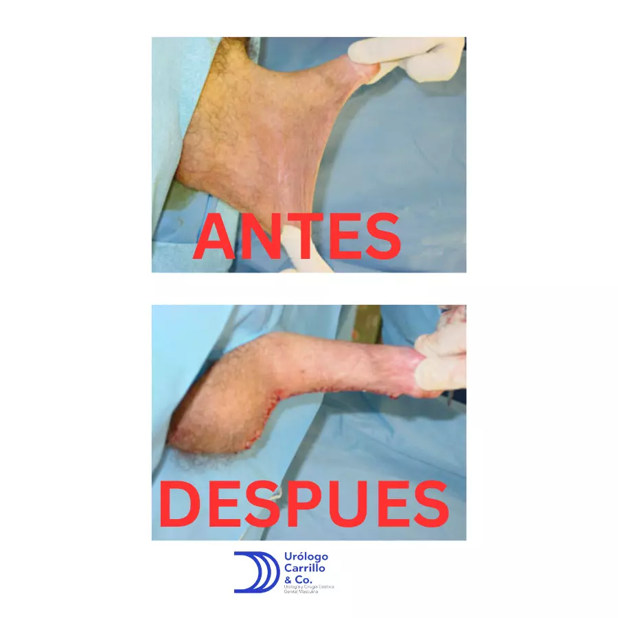 Antes y después de una escrotoplastia, con una mejoría impresionante e inmediata 