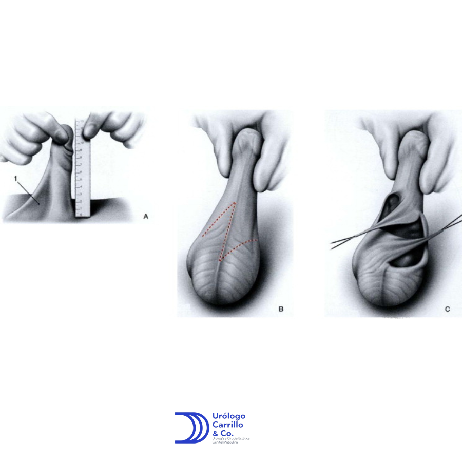 Una tecnica de escrotoplastia en casos de escrotos redundantes pero con red pene escrotal es la zetaplastia escrotal 