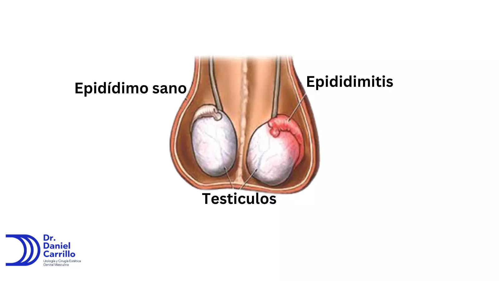 La epididimitis es la inflamación del epididimo