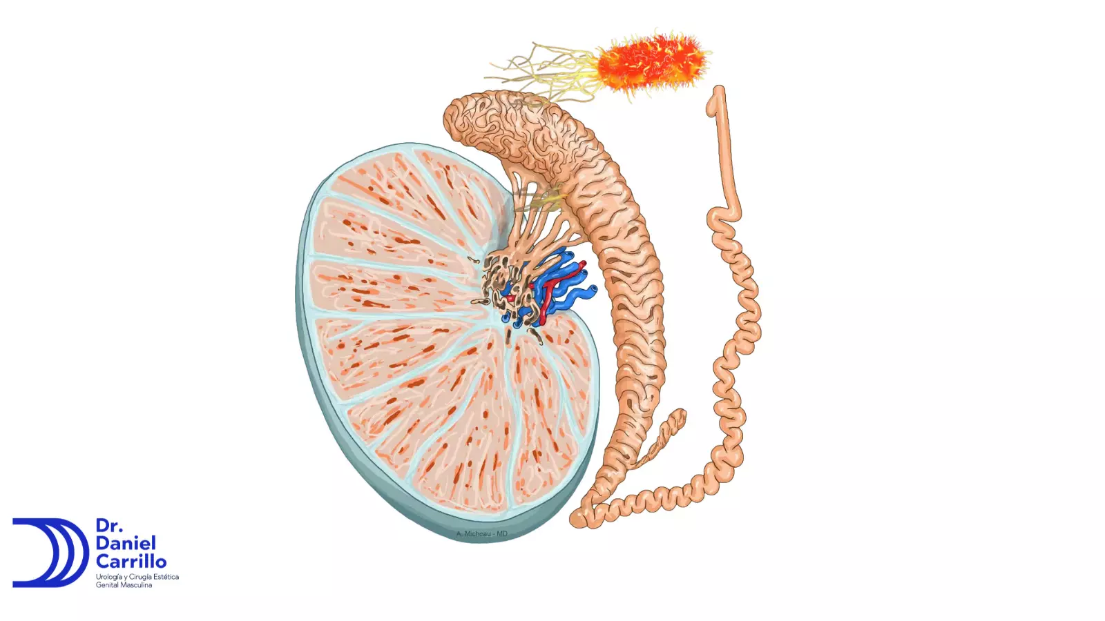 Las infecciones bacterianas son la principal causa de epididimitis