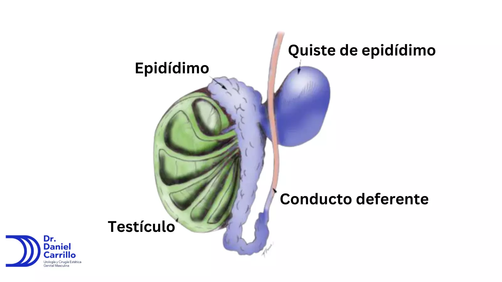 Anatomía de un quiste de epidídimo 
