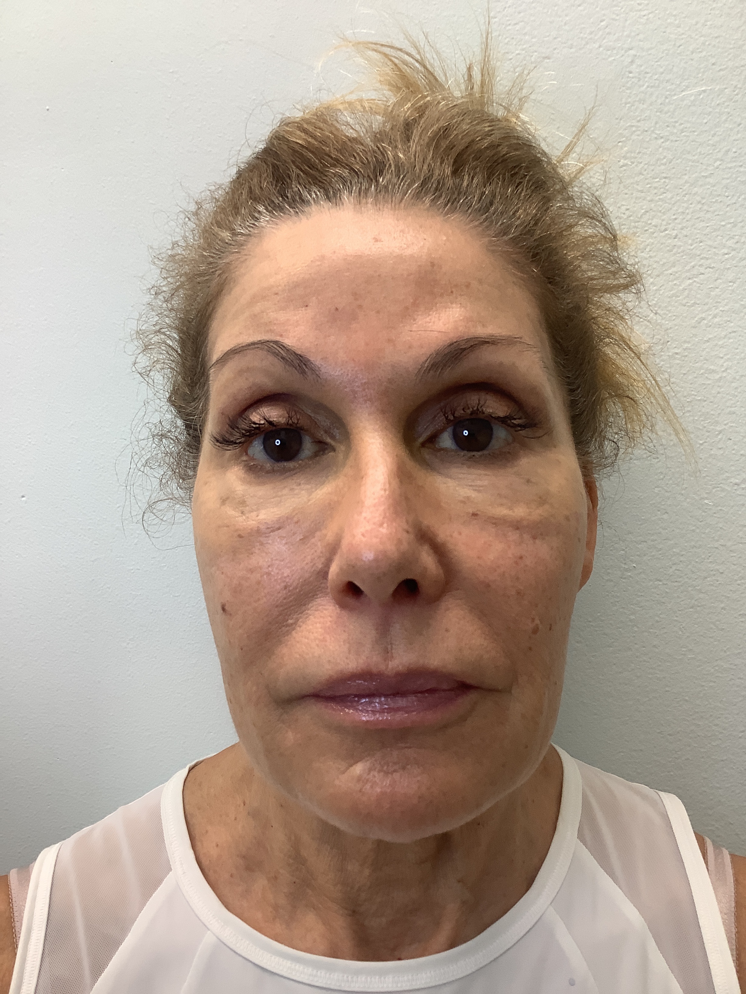 Before Morpheus8 treatment, RevitalIV patient