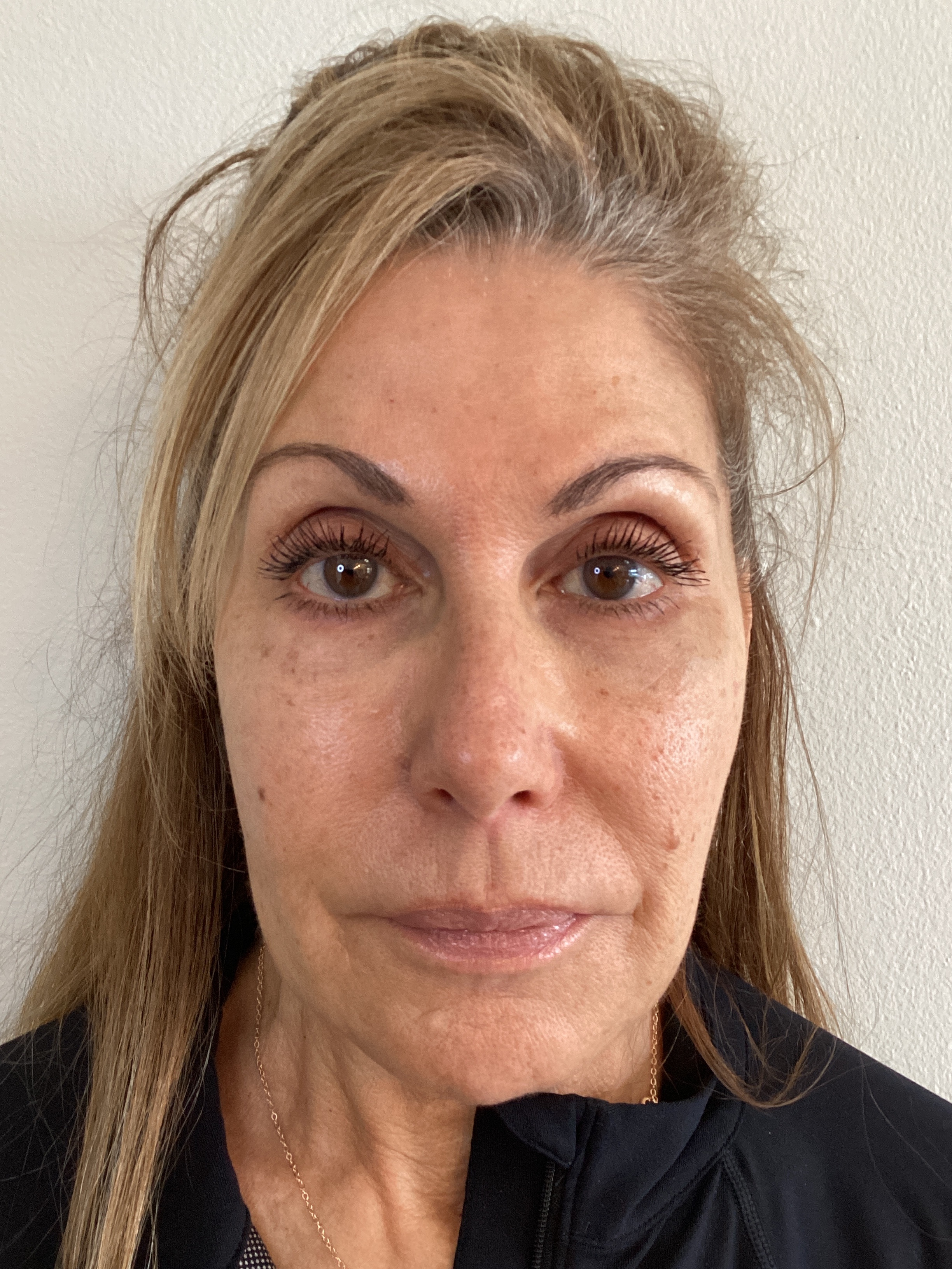After Morpheus8 treatment, RevitalIV patient