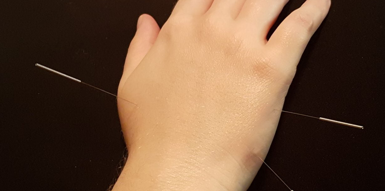 What Is Distal Acupuncture