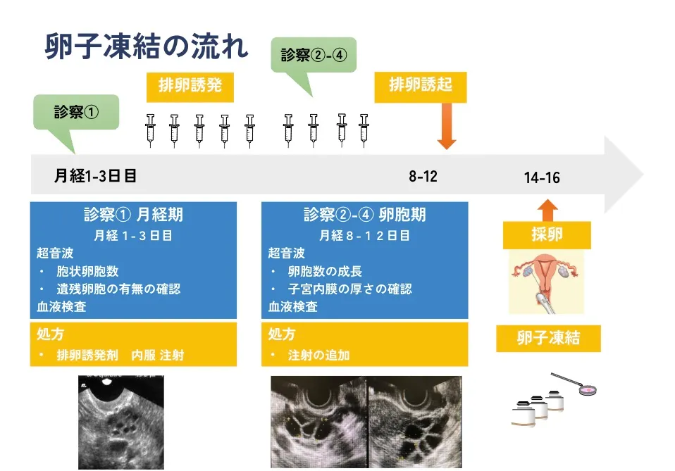 卵子凍結の流れ