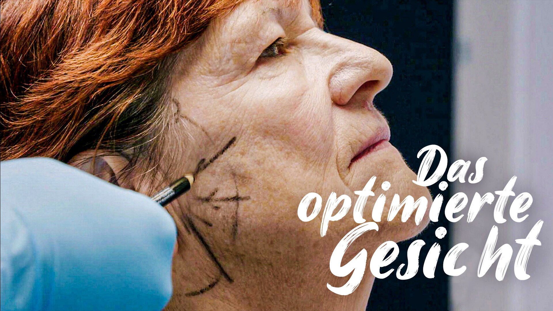 Face Lifting
