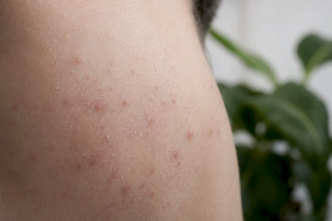 Close-up of acne purge skin redness and flaking