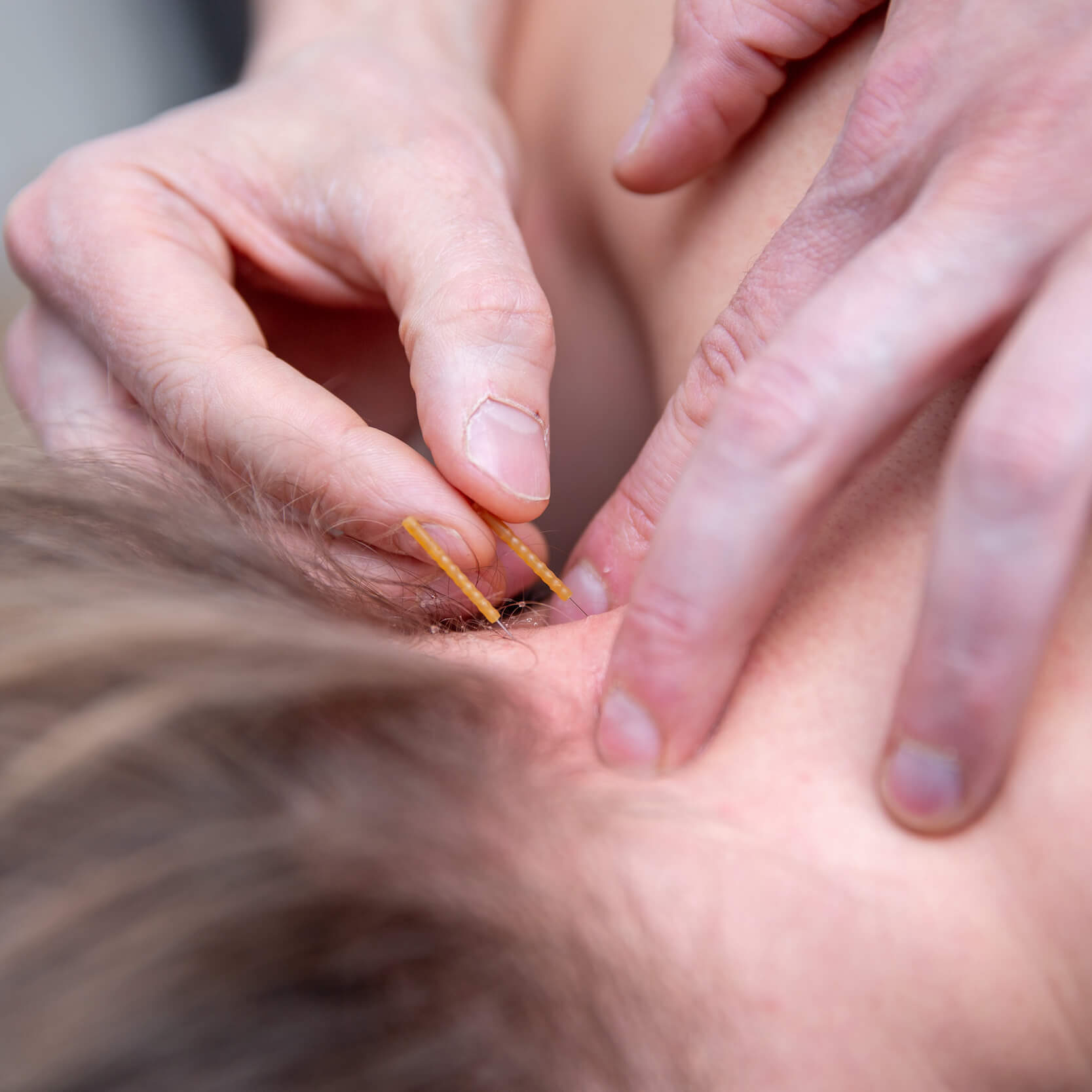 Dry Needling an der Nackenmuskulatur