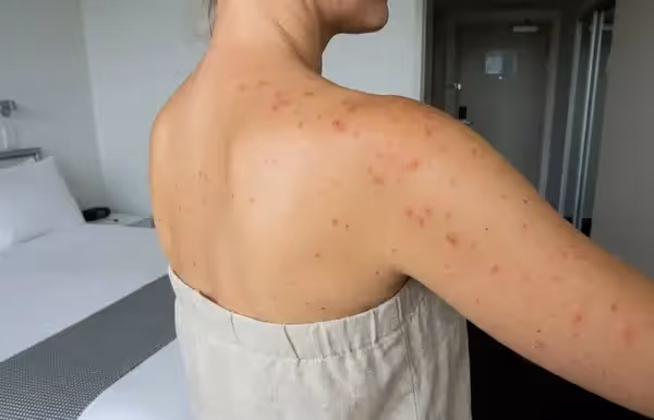 Piqûre la nuit dans le lit : Moustique, Araignée ou Punaise ? Le diagnostic