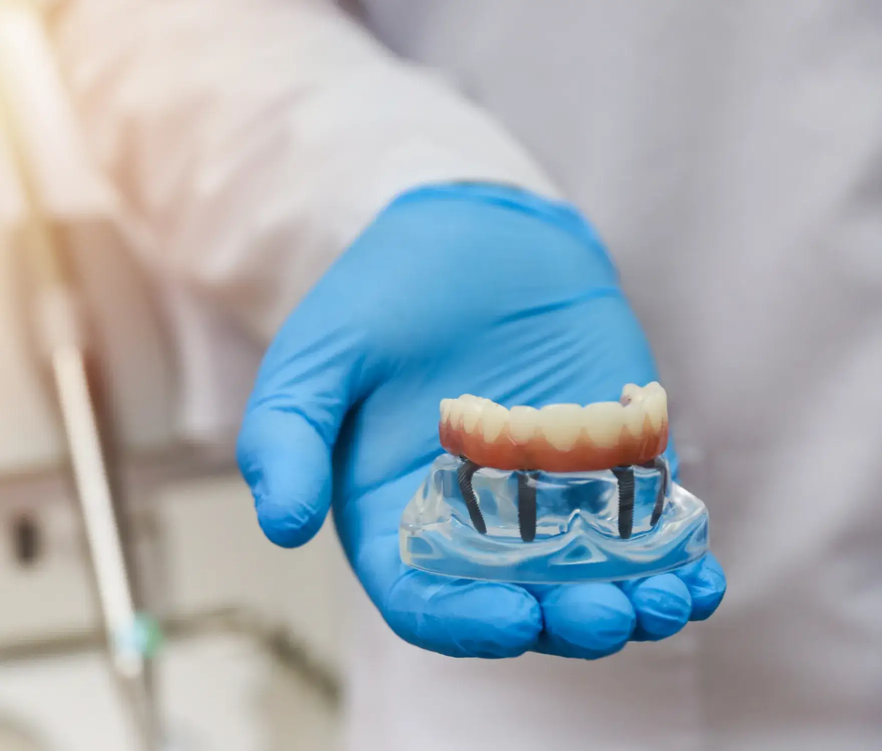 A person in a lab coat holds a dental model with implants using a gloved hand.