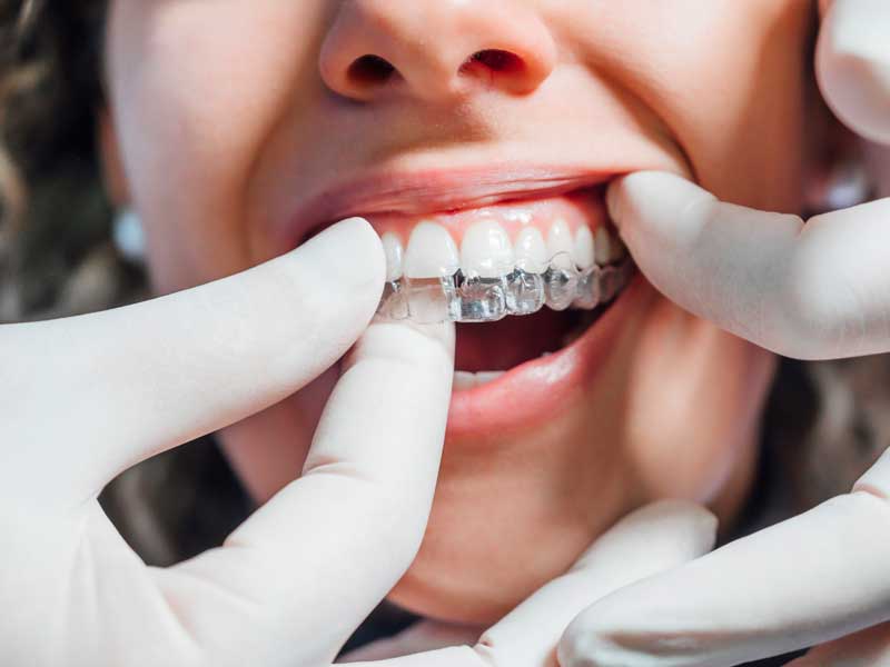 Let’s Make One Thing ClearCorrect | Riverside Dentist