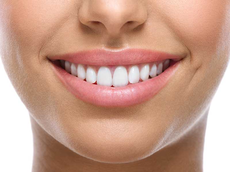 Smile Improvements Made by Veneers | Riverside, CA