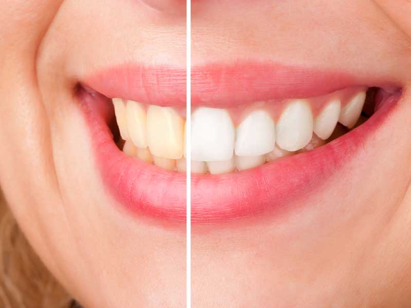 Why Are My Teeth Discolored? | Riverside Dentist