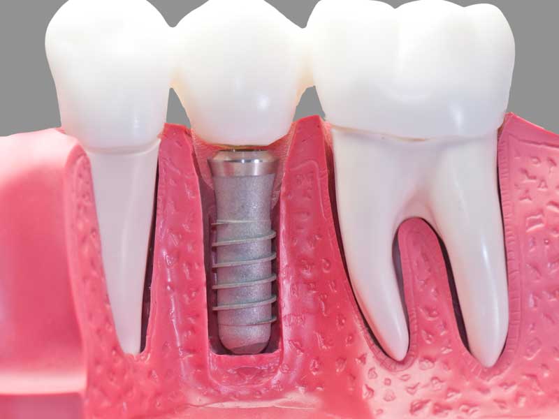 The ABCs of Dental Implants | Dentist in Riverside, CA
