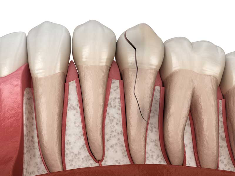 Five Things That Can Be Damaging Your Teeth | Riverside, Ca Dentist