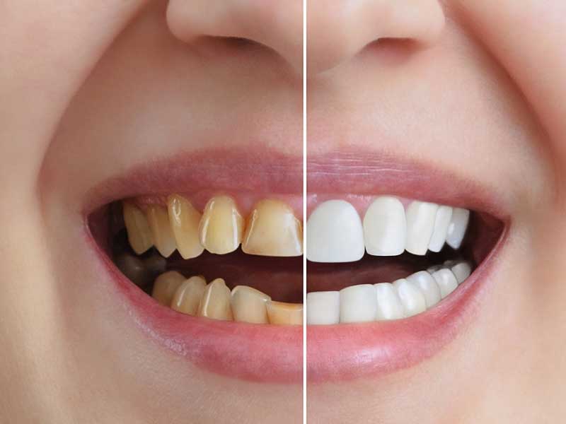 Say Goodbye to Mercury! Tooth Colored Fillings|Serving Ontario, CA