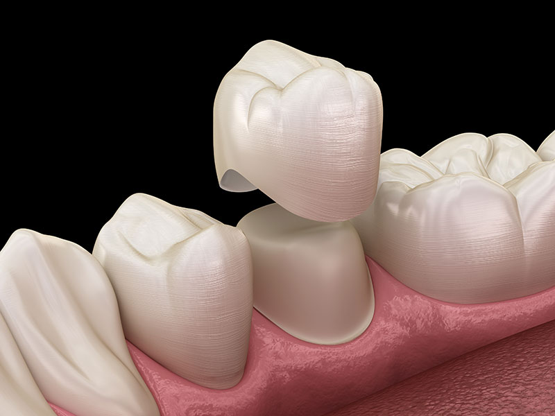 CEREC Same Day Crowns: A Healing Touch for Damaged Teeth