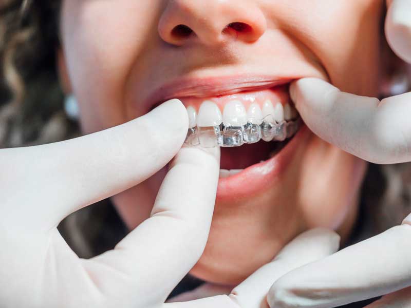 Braces Make Beautiful Faces: Braces vs. Invisalign | Dentist Riverside CA