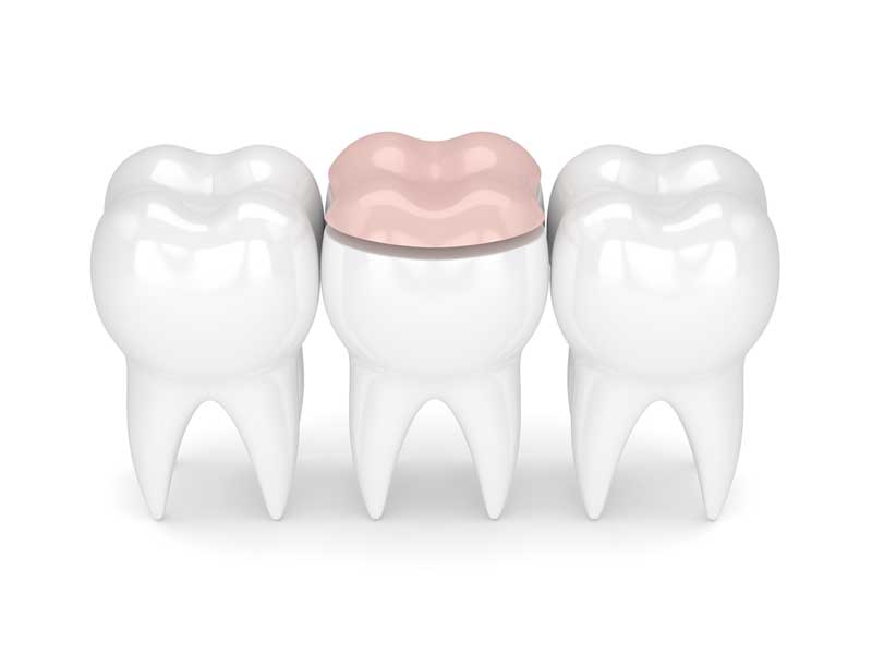 Dental Crowns in a Day | Riverside, CA