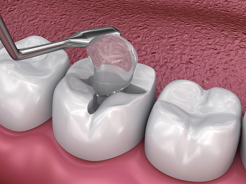 How to Care for Your Cavity Filling: 5 Essential Aftercare Tips for Riverside, CA Patients