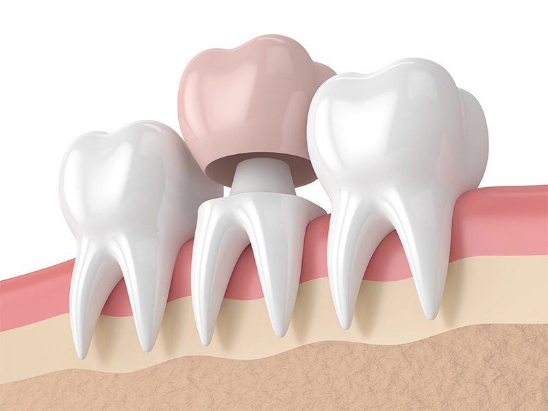 The Ultimate Guide to CEREC Tooth Crowns in Riverside, CA: 5 Top Questions Explained