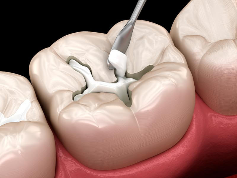 The six benefits of using composite materials for dental tooth fillings
