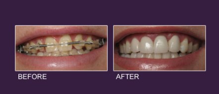 Veneer Before After 3