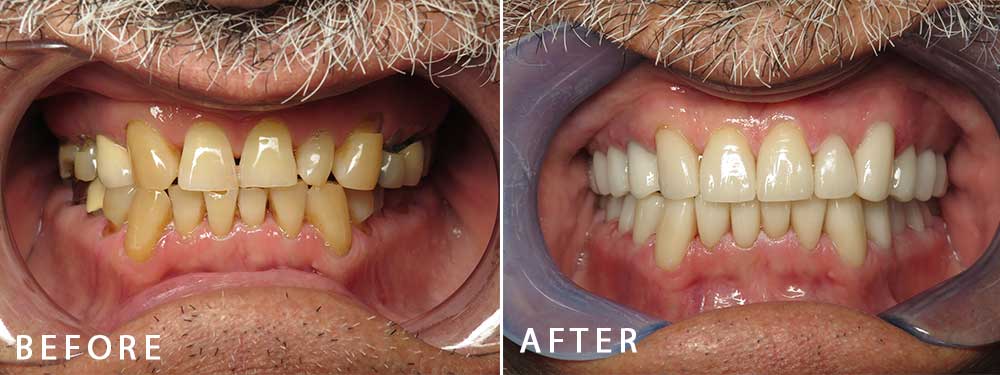 Rebuilding a Smile With Crowns Before After 2