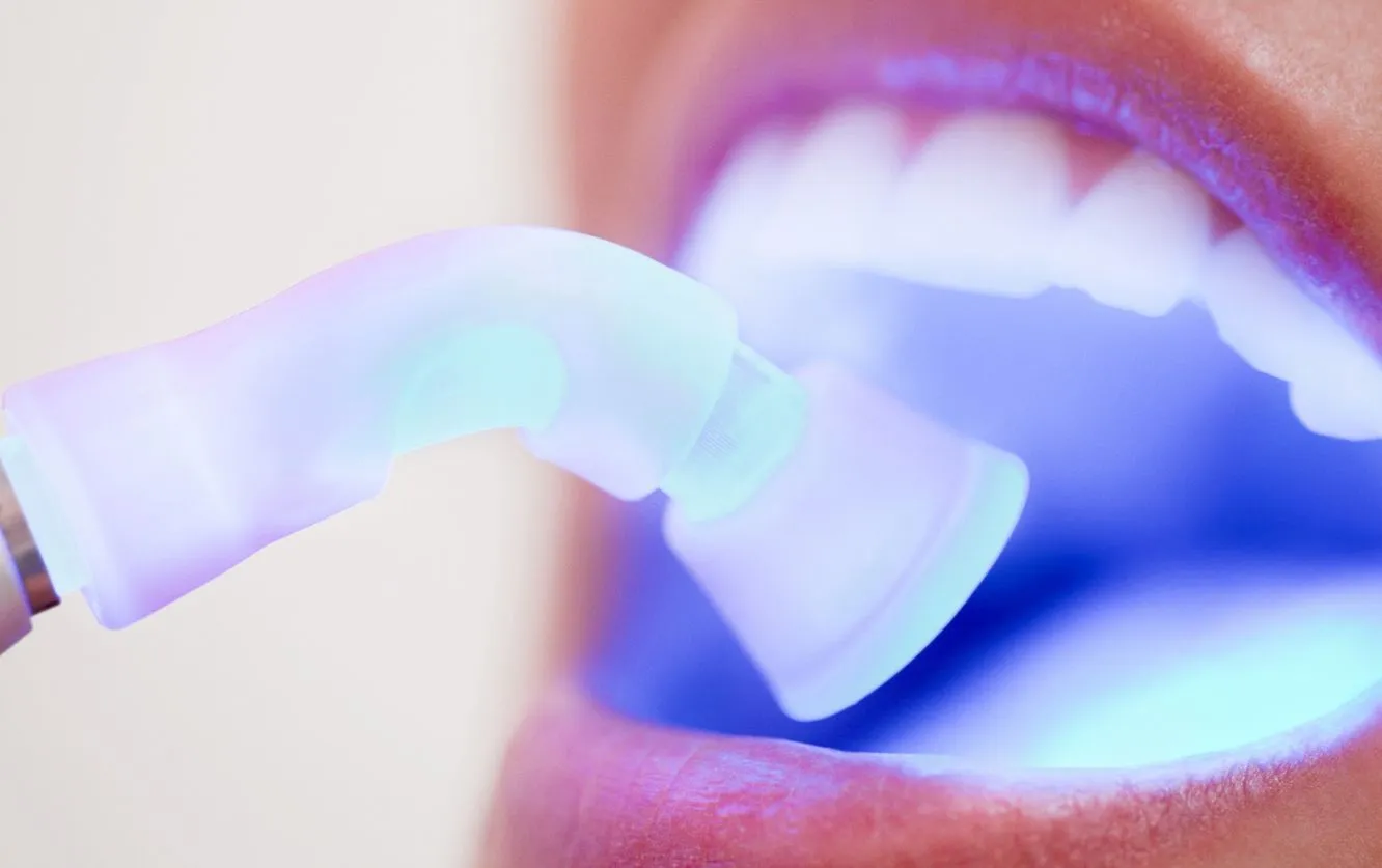 Extreme close-up of a dental curing light emitting a bright blue-violet glow as it is applied to the surface of a patient’s teeth. The patient’s mouth is open, revealing clean, white teeth while the polymerization light is focused on a specific tooth area, commonly used for hardening composite resin during dental bonding, fillings, or sealants. The glowing illumination highlights the precision and effectiveness of the light-curing process in modern dentistry