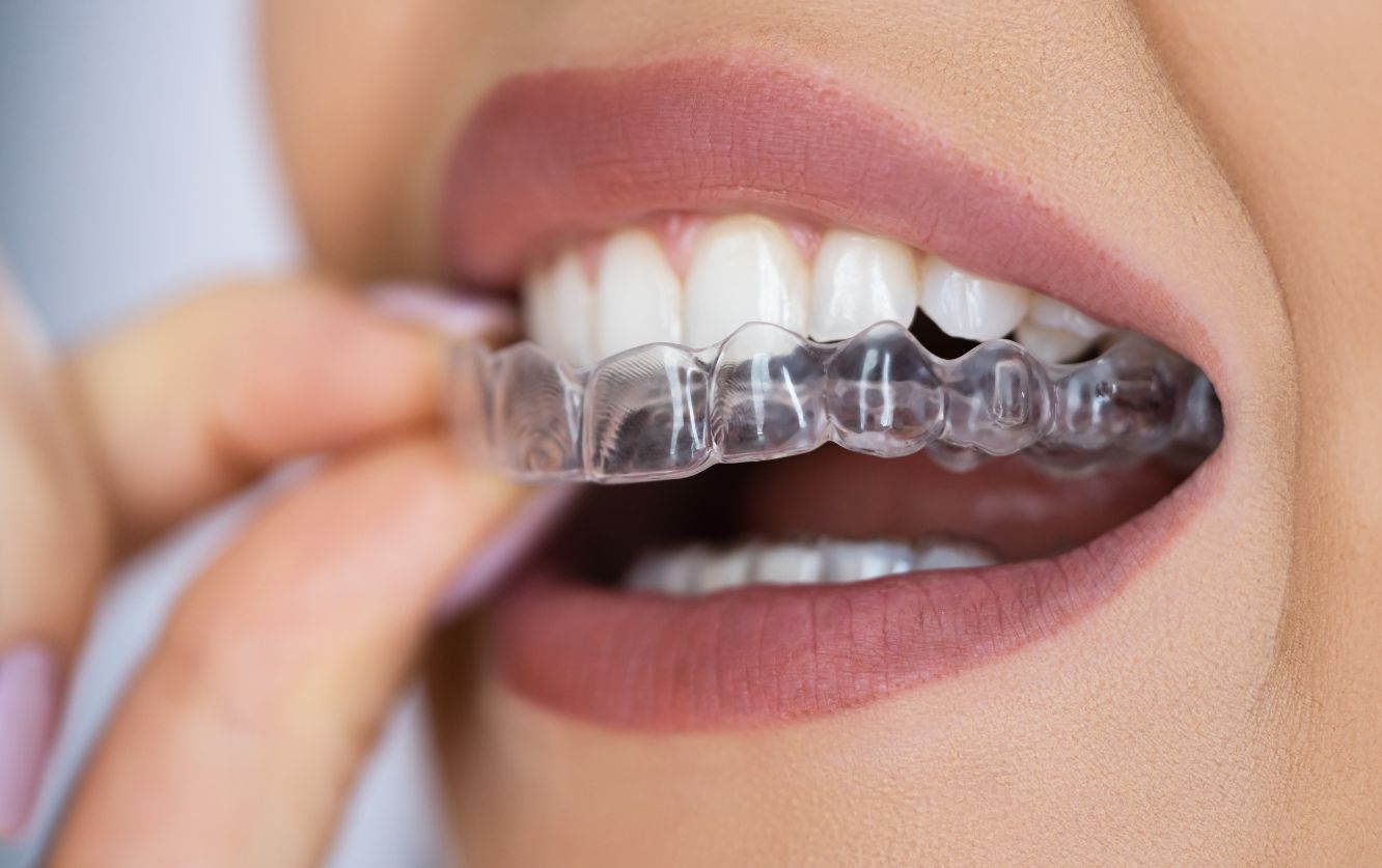 Smiling female patient inserting a clear removable aligner tray onto her upper teeth during an Invisalign treatment session for orthodontic correction