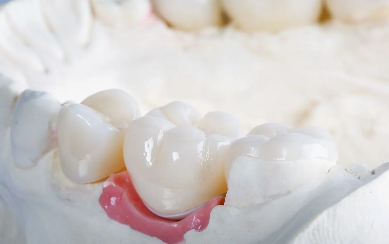 Removable orthodontic retainer with pink acrylic base and metal clasp, positioned on a white plaster model for post-braces retention treatment