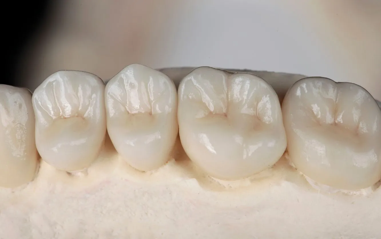 Close-up of a zirconia crown fitted onto a molar in a stone model, showing detailed occlusal grooves and contact points for posterior bite alignment