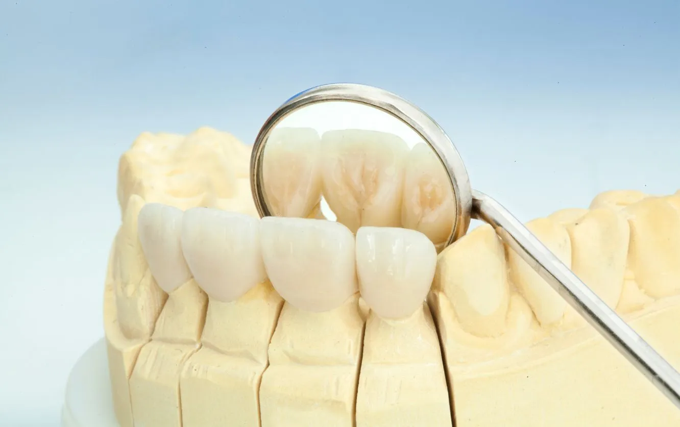 Metal dental explorer tool resting on a row of full ceramic anterior crowns mounted to a model for final contour check before cementation