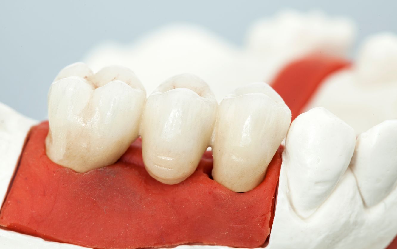 Row of white ceramic crowns aligned on a red wax base for quality inspection and occlusal surface adjustment prior to dental crown delivery