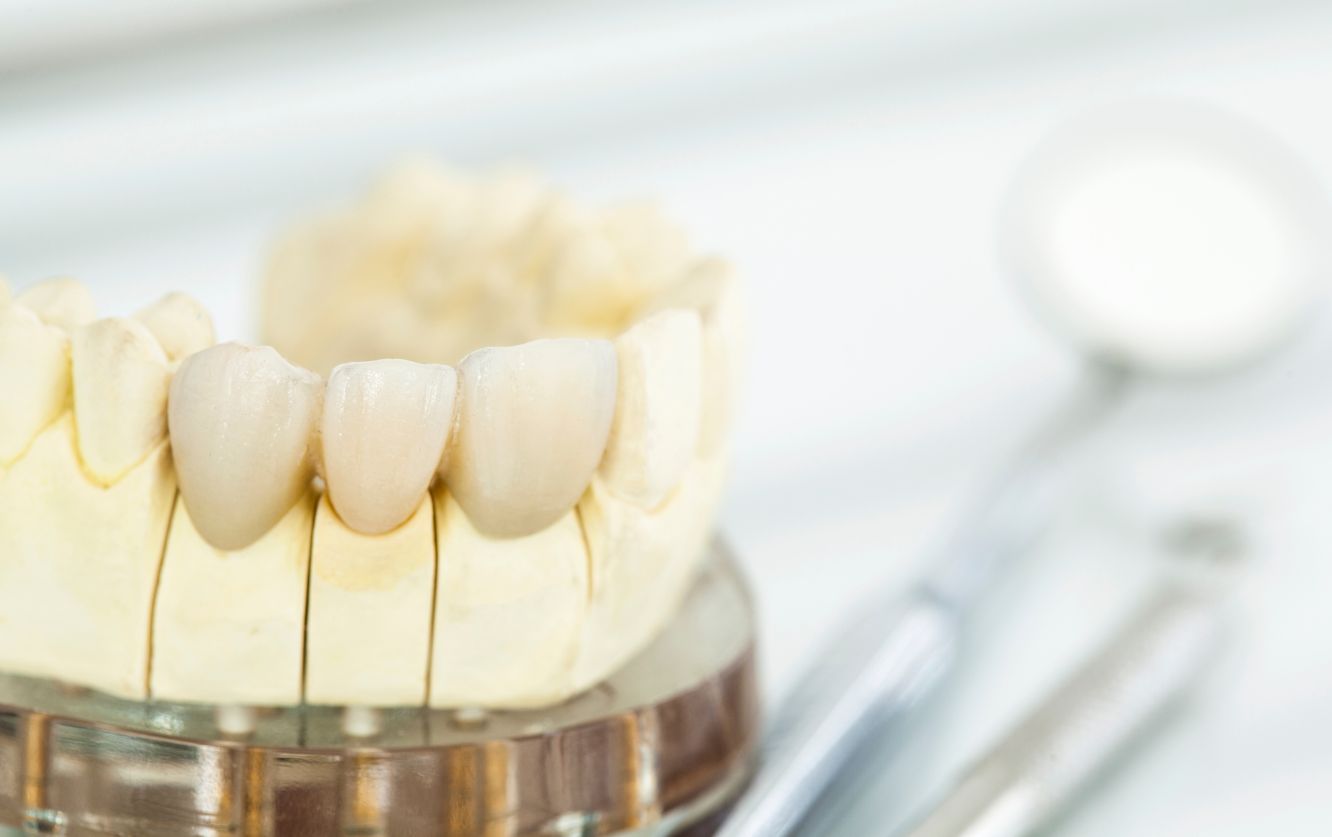 Set of six ceramic crowns cemented onto a stone model representing the upper jaw, showcasing detailed gingival margins and natural occlusal anatomy for anterior restorations