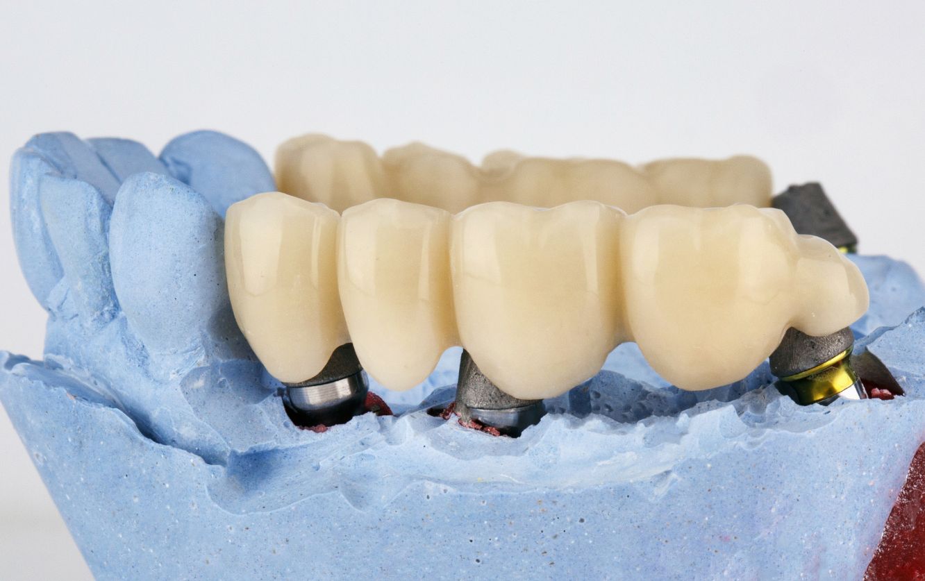 Blue stone dental mold holding multiple anterior crowns in various tooth shades for aesthetic matching during a smile restoration case