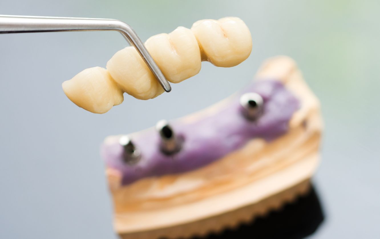 Close-up of a gloved hand placing a three-unit fixed dental bridge onto a violet-colored stone model, illustrating posterior tooth replacement in restorative dentistry