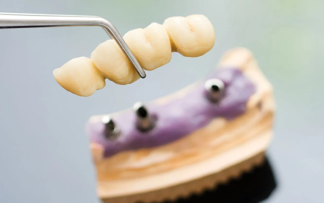 Close-up of a gloved hand placing a three-unit fixed dental bridge onto a violet-colored stone model, illustrating posterior tooth replacement in restorative dentistry