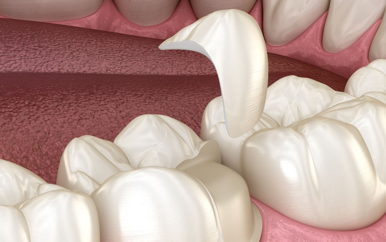 Macro shot of dental crowns being precisely positioned onto pink gum-colored implant abutments during a fixed prosthodontic procedure