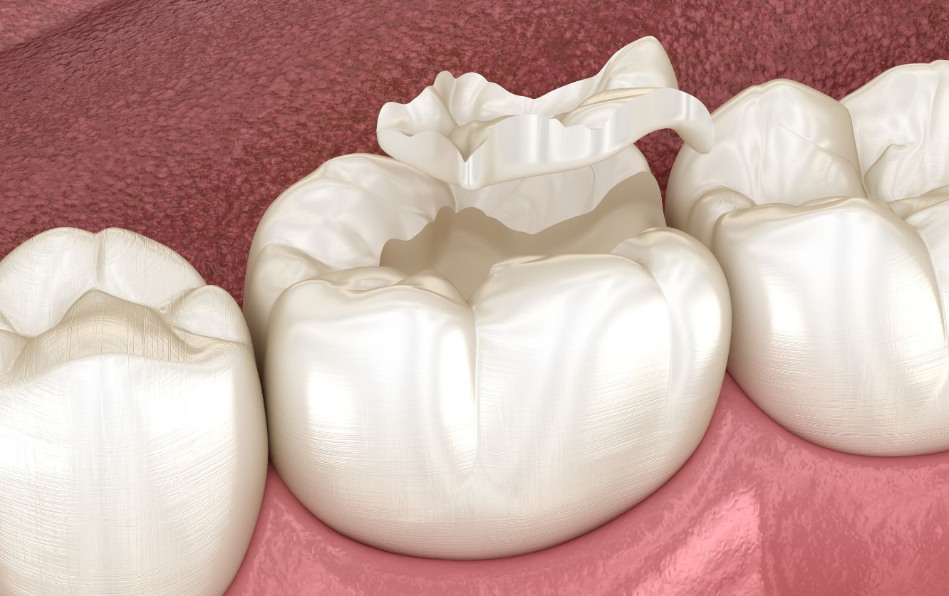 Close-up of a row of zirconia dental crowns fitted on molar-shaped models, displaying detailed occlusal surfaces and natural white shading for crown restorations