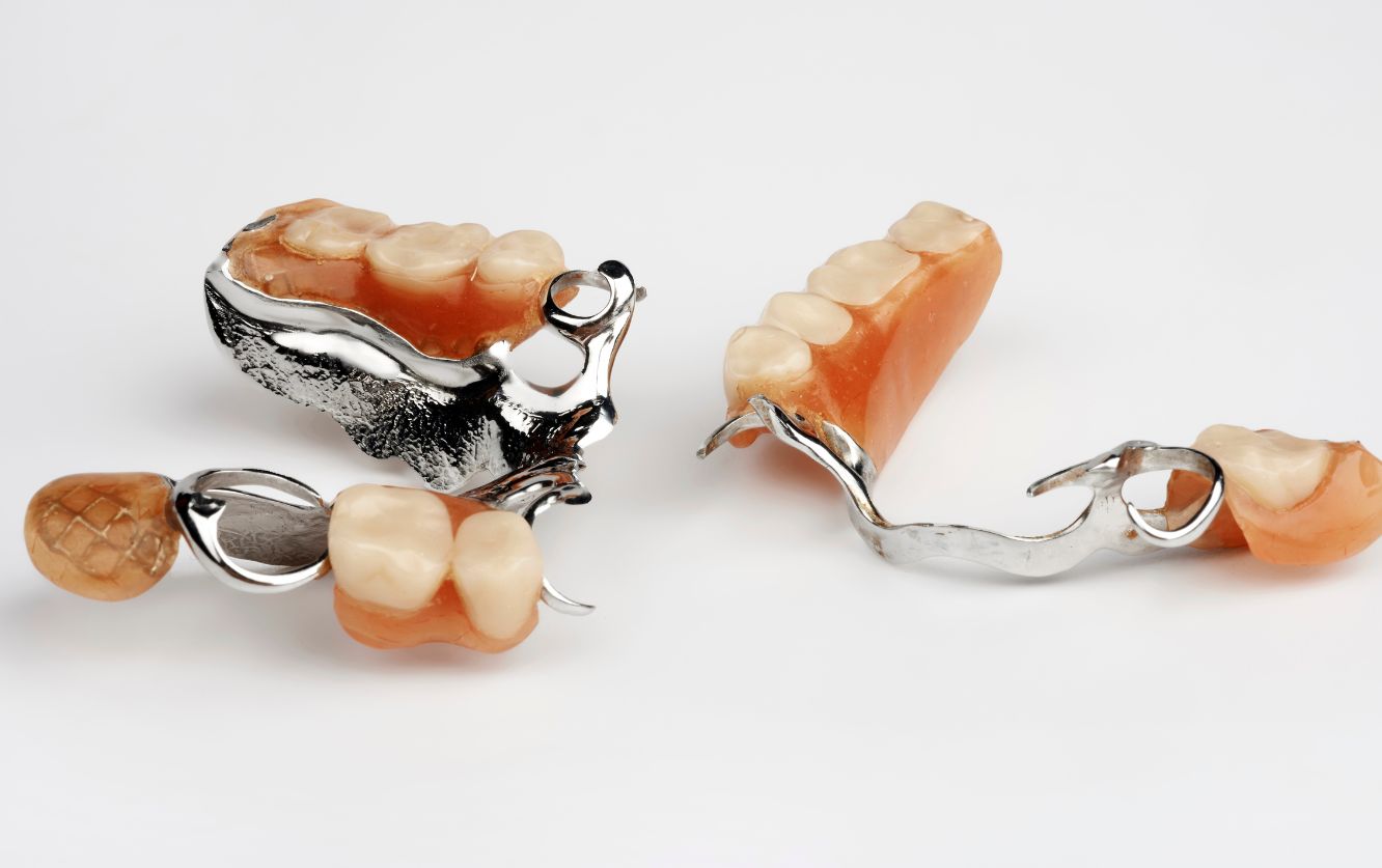 Close-up of a partial denture appliance with metal clasps and artificial teeth, designed for restoring missing molars in a patient with partial tooth loss