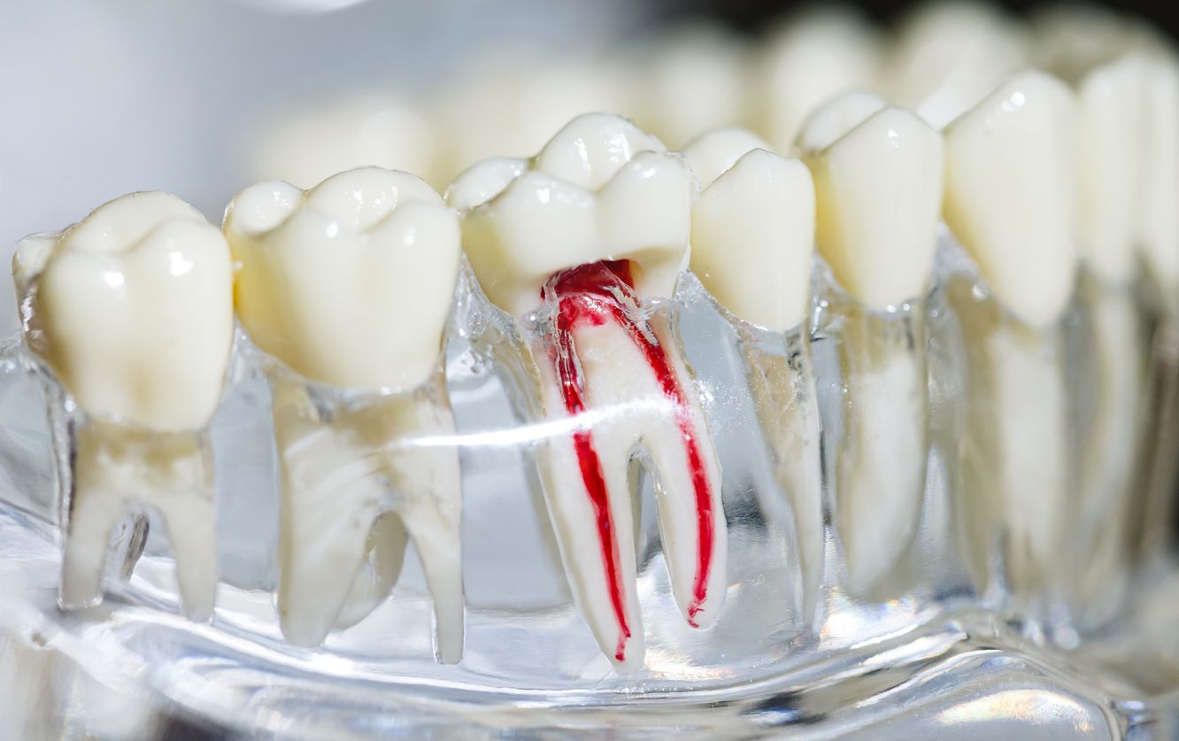Dental prosthetics display model showing a full upper arch with multiple titanium dental implants surgically embedded in a clear jaw, supporting ceramic crowns for patient education and implant consultation