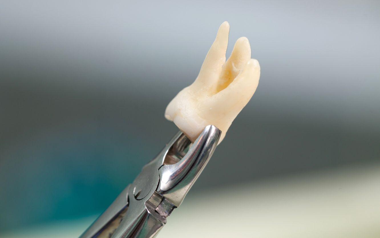 Macro image of a gloved hand holding a realistic titanium dental implant with abutment and porcelain crown, used for single-tooth replacement in restorative dental procedures