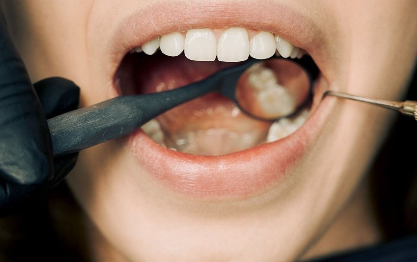 Extreme close-up of a dental professional using a stainless steel mouth mirror and scaler to inspect plaque and tartar buildup on a patient's lower molars during an in-office oral hygiene examination