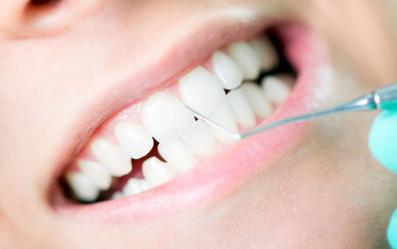 Extreme close-up of a dental hygienist using a scaler tool to gently remove plaque and tartar buildup from a patient's lower front teeth during a professional cleaning at Fortson Dentistry in Lathrup Village, MI