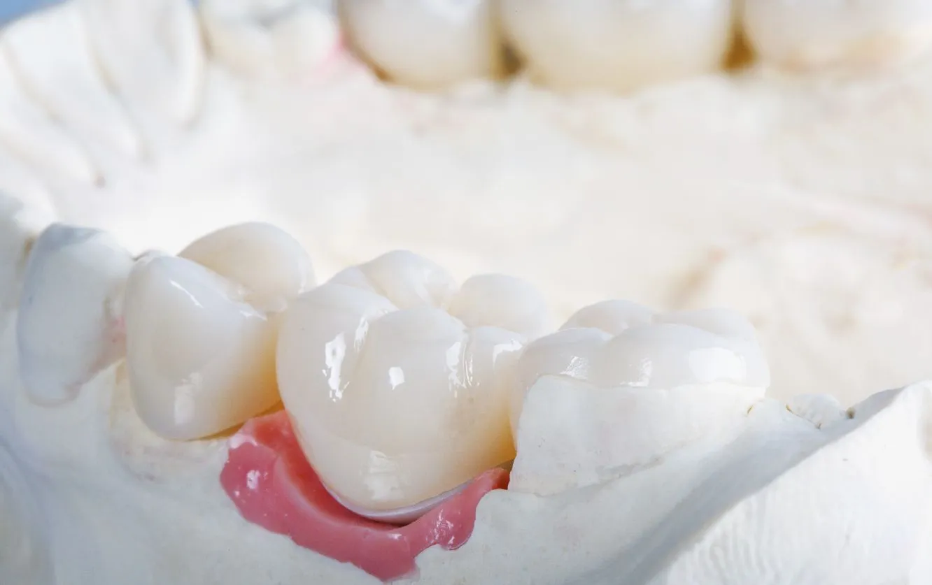 Close-up of a dental crown model showcasing a set of three natural-looking porcelain crowns fitted over molars on a pink gum base, used for restorative dental procedures