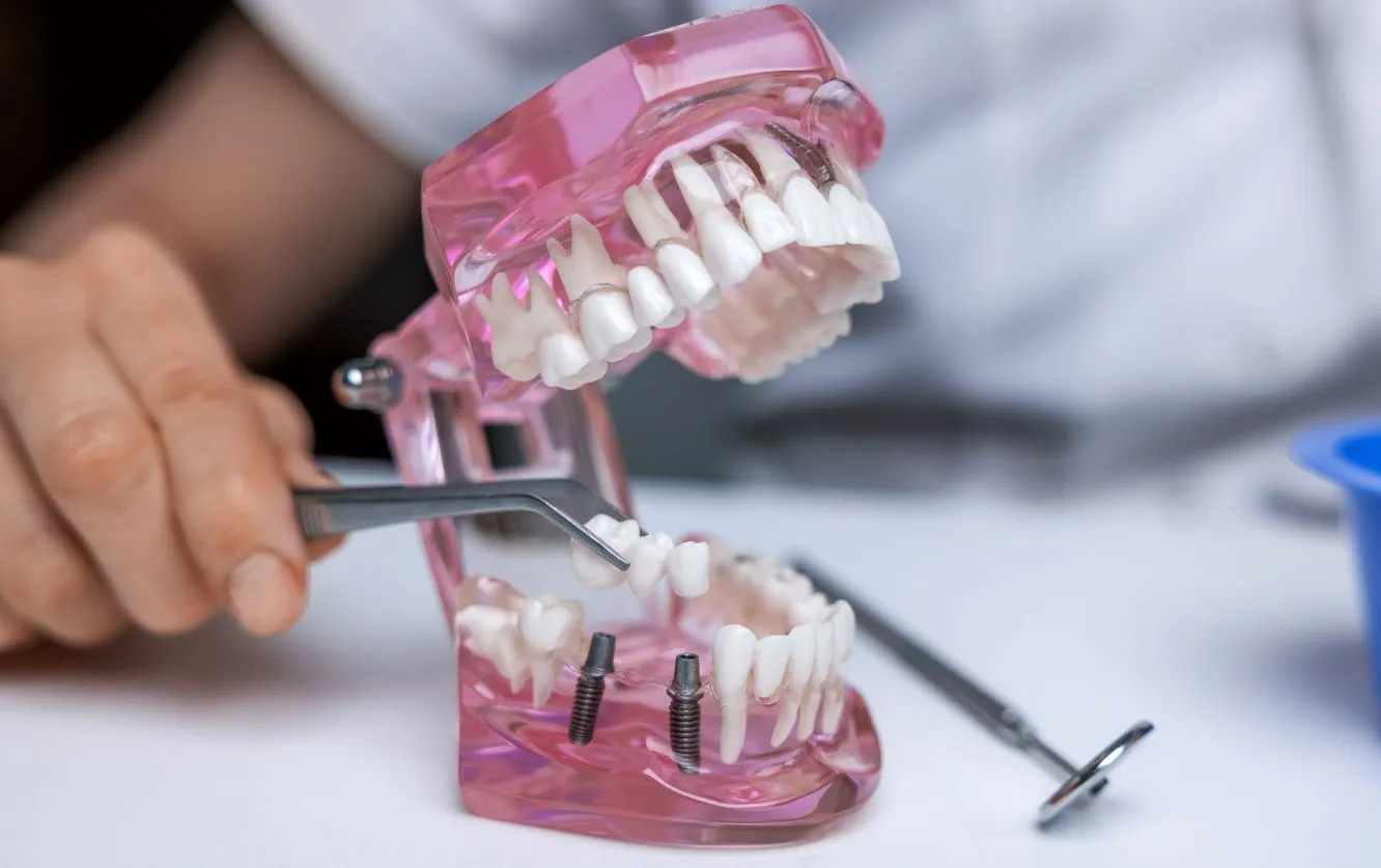 Close-up of a dental professional using tweezers to place a prosthetic tooth onto a pink dental model with visible dental implants, demonstrating how implant-supported bridges or crowns are fitted