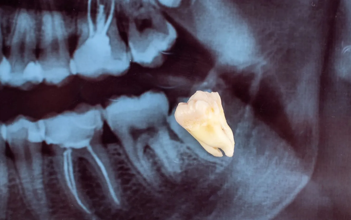 Panoramic dental X-ray image showing impacted wisdom teeth, overlaid with an extracted molar tooth in the foreground, illustrating the process and outcome of surgical tooth extraction